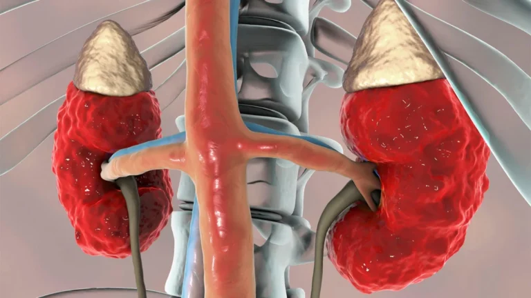 The TRACK Trial: Why a Standard Blood-Thinner Regimen Failed Patients with Advanced Kidney Disease