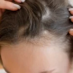 A Potential Breakthrough: Veradermics’ Oral Minoxidil Paves the Way for Female Hair Loss Treatment