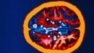 A Potential Shift in Multiple Sclerosis Care: The OVERLORD-MS Trial Challenges Cost Paradigms