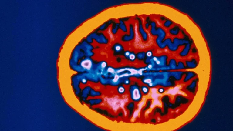 A Potential Shift in Multiple Sclerosis Care: The OVERLORD-MS Trial Challenges Cost Paradigms