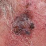 A Turning Point for RP1: Advisory Committee Backs Controversial Melanoma Therapy Despite FDA Skepticism