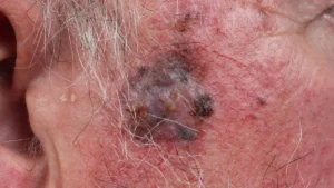 A Turning Point for RP1: Advisory Committee Backs Controversial Melanoma Therapy Despite FDA Skepticism