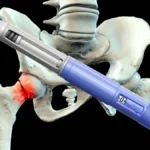 Beyond Glycemic Control: GLP-1 Agonists Linked to Reduced Fracture Risk in Type 2 Diabetes Patients
