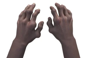 Crystalys Therapeutics Secures $130 Million to Propel Gout Drug Dotinurad Toward Market Entry
