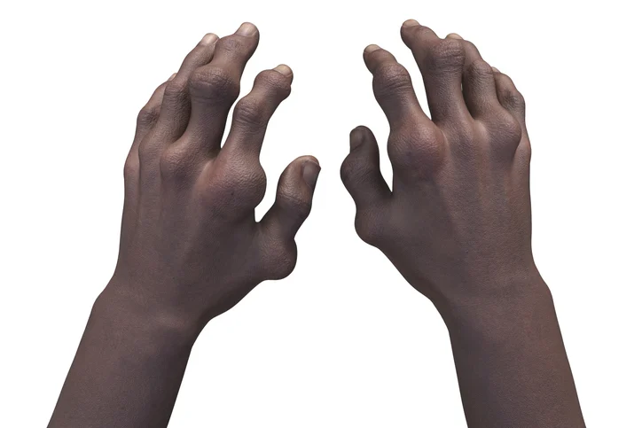 Crystalys Therapeutics Secures $130 Million to Propel Gout Drug Dotinurad Toward Market Entry