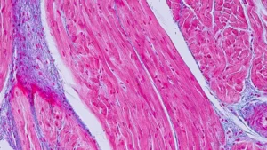 Medtronic Bets on CoreMap: A Strategic Pivot to Precision in Atrial Fibrillation Treatment