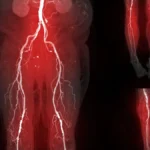 Pregnancy Complications as Early Warning Signs: New Research Links Birth Outcomes to Lifelong Peripheral Artery Disease Risk