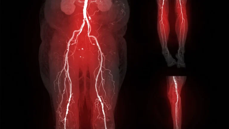Pregnancy Complications as Early Warning Signs: New Research Links Birth Outcomes to Lifelong Peripheral Artery Disease Risk