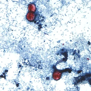 Public Health in Peril: The Mystery Behind the Historic Cyclospora Outbreak