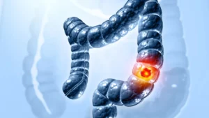 The Blood-Based Frontier: How Freenome and Abbott Are Reshaping Colorectal Cancer Screening