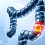 The Future of Non-Invasive Diagnostics: Freenome and Abbott Set Sights on Colorectal Cancer Screening Dominance