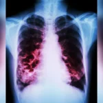 The Syndemic Burden: How Diabetes Exacerbates Bronchiectasis Outcomes