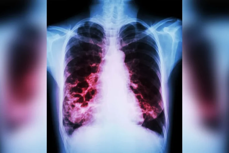 The Syndemic Burden: How Diabetes Exacerbates Bronchiectasis Outcomes