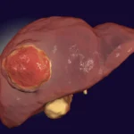 A Breakthrough in the Shadows: New Hope for Treating Fibrolamellar Carcinoma