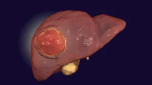 A Breakthrough in the Shadows: New Hope for Treating Fibrolamellar Carcinoma