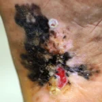 A New Frontier or a Regulatory Gamble? FDA Grants Accelerated Approval to Vusolimogene Oderparepvec for Advanced Melanoma