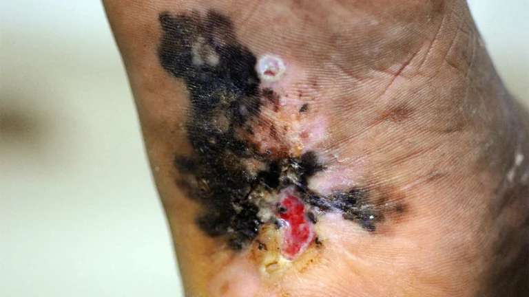 A New Frontier or a Regulatory Gamble? FDA Grants Accelerated Approval to Vusolimogene Oderparepvec for Advanced Melanoma