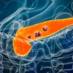 A New Horizon in Oncology: FDA Approves Daraxonrasib as First-in-Class Treatment for Metastatic Pancreatic Cancer