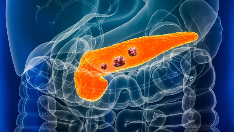 A New Horizon in Oncology: FDA Approves Daraxonrasib as First-in-Class Treatment for Metastatic Pancreatic Cancer