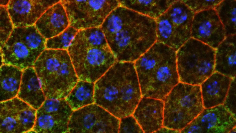 A Potential Breakthrough in Vision Loss: How Cholesterol Metabolism May Be the Key to Stopping Macular Degeneration