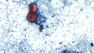 A Rare Tragedy: Michigan Reports First U.S. Deaths Linked to Cyclospora Outbreak