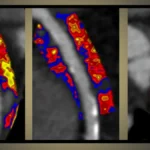 AI-Powered Cardiac Breakthrough: Caristo Diagnostics Prepares for U.S. Launch of Heart-Risk Assessment Tool