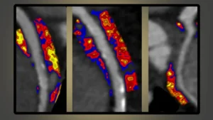 AI-Powered Cardiac Breakthrough: Caristo Diagnostics Prepares for U.S. Launch of Heart-Risk Assessment Tool