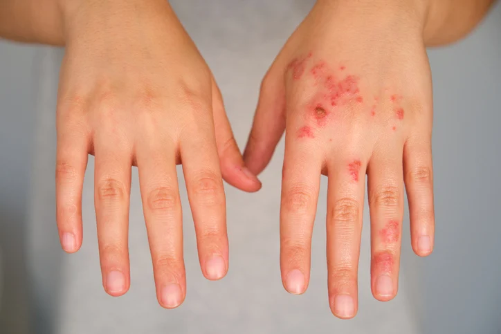 Attovia Therapeutics Secures $289 Million IPO to Revolutionize Biologic Treatment of Immune-Mediated Diseases