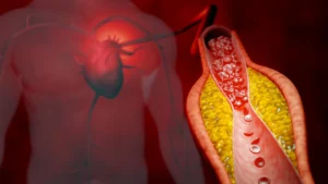 Beyond LDL: Is a New Blood Test the Future of Cardiovascular Health?
