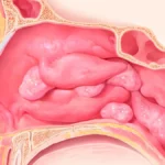 Beyond Management: New Real-World Evidence Highlights Remission Potential for Mepolizumab in CRSwNP