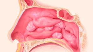 Beyond Management: New Real-World Evidence Highlights Remission Potential for Mepolizumab in CRSwNP
