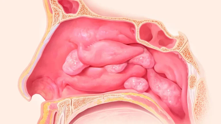 Beyond Management: New Real-World Evidence Highlights Remission Potential for Mepolizumab in CRSwNP