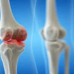 Beyond the Ache: Navigating the Complex Reality of Knee Osteoarthritis