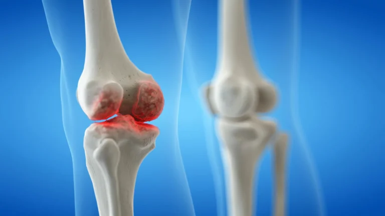 Beyond the Ache: Navigating the Complex Reality of Knee Osteoarthritis