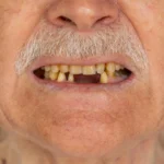 Beyond the Smile: New Research Links Dental Health to Pancreatic Cancer Survival