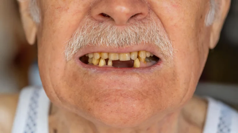 Beyond the Smile: New Research Links Dental Health to Pancreatic Cancer Survival