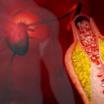 Beyond the Standard Lipid Panel: Why a New Cholesterol Test Could Revolutionize Heart Health