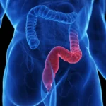 Beyond Weight Loss: GLP-1 Receptor Agonists Show Potential in Treating Ulcerative Colitis