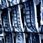 BioMarin Expands Rare Disease Portfolio with Strategic Acquisition of Alesta Therapeutics