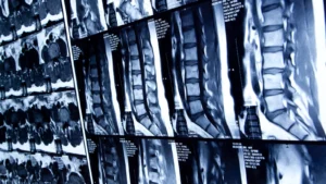 BioMarin Expands Rare Disease Portfolio with Strategic Acquisition of Alesta Therapeutics