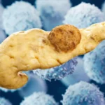 Breaking the Cycle: Novel KRAS Vaccine Shows Promise in Intercepting Pancreatic Cancer
