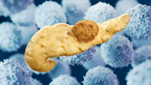 Breaking the Cycle: Novel KRAS Vaccine Shows Promise in Intercepting Pancreatic Cancer