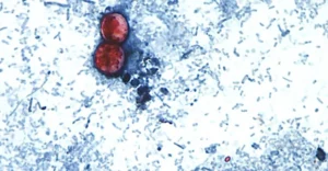 Deadly Parasite Outbreak: Michigan Records First U.S. Deaths Linked to Cyclospora