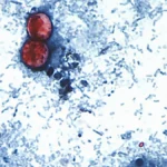 Largest Cyclospora Outbreak in U.S. History Surpasses 11,400 Cases; Expansion into 20 States Raises Alarm