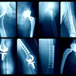 Navigating the Shift: Orthopedic Giants Unfazed by Medicare’s New CJR-X Payment Model