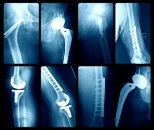 Navigating the Shift: Orthopedic Giants Unfazed by Medicare’s New CJR-X Payment Model