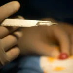 New Research Debunks Link Between Neonatal Circumcision and Autism Spectrum Disorder