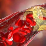 Preventive Cardiology Breakthrough: PCSK9 Inhibitor Evolocumab Shows Promise for High-Risk Diabetes Patients