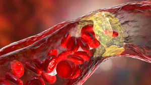 Preventive Cardiology Breakthrough: PCSK9 Inhibitor Evolocumab Shows Promise for High-Risk Diabetes Patients