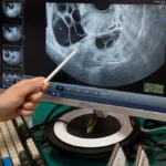 Rethinking Ovarian Cancer: How a Shift in Scientific Understanding is Transforming Prevention